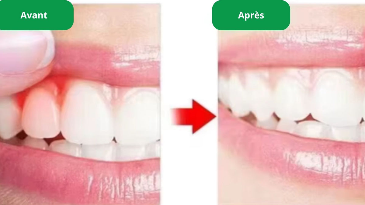 Spray Dentaire-Antidouleur Dentaire